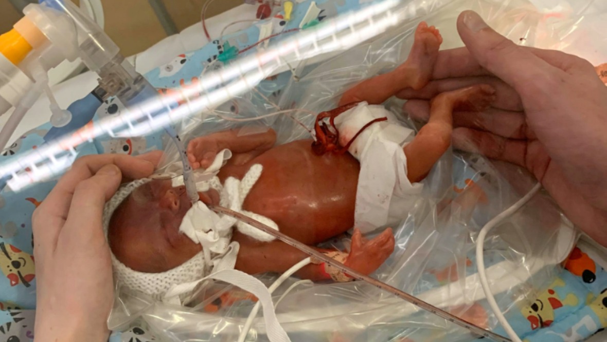 One-pound baby defies odds to celebrate first birthday