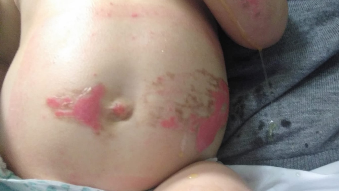 Injuries: Alfie was left with burn marks.