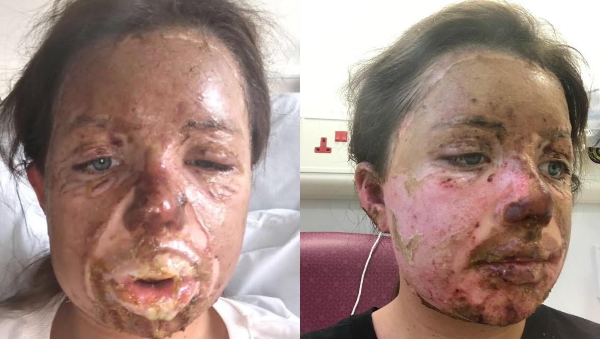 Grace suffered serious facial burns in the explosion.
