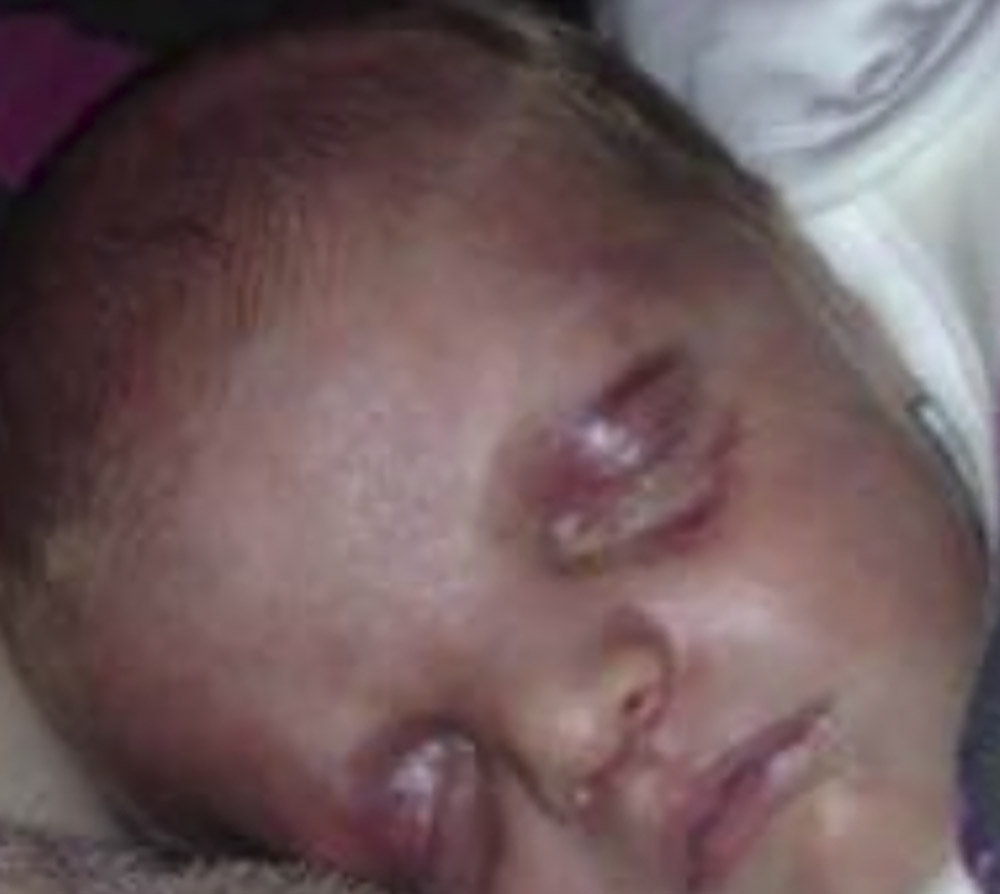 Collect of Mia-Rose who was born with two black eyes and bruised cheeks stopping her being able to feed properly.