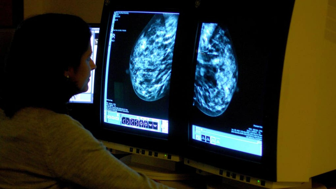 Poorest women ‘less likely to attend breast cancer screening’