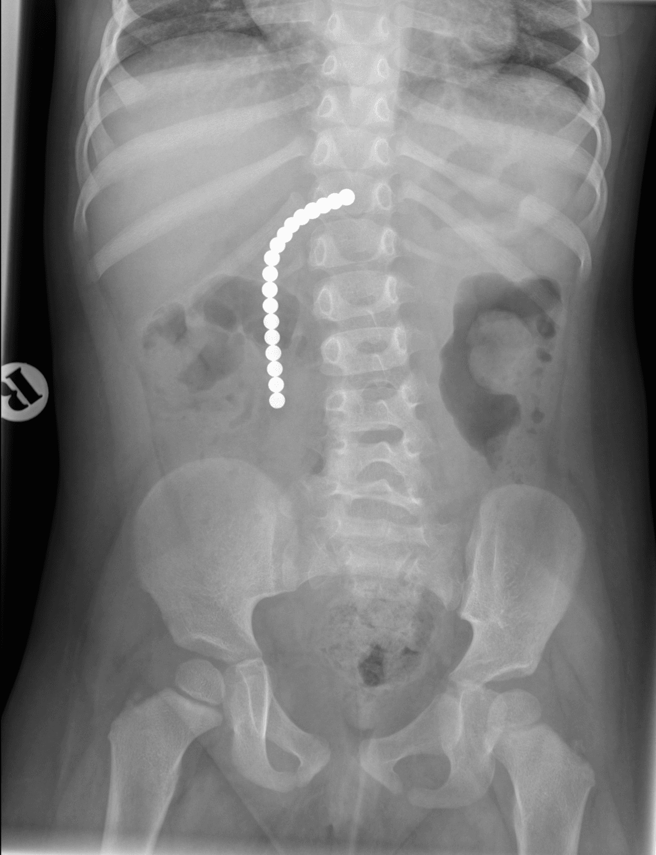 An X-ray of a patient who swallowed 18 magnets.