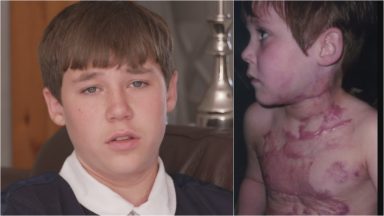 Teen scarred in freak firework accident still needs surgery ten years on