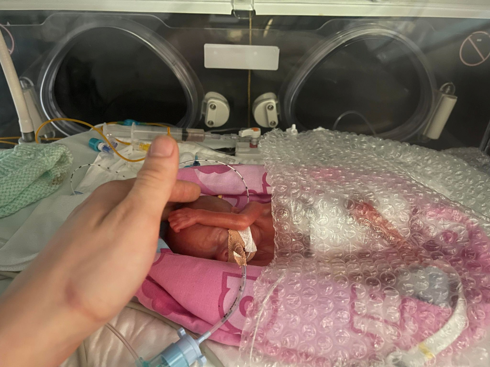 Hannah Stibbles was born 25 weeks premature.