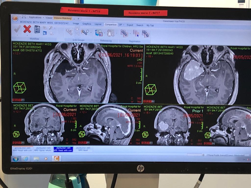 The brain tumour was the size of an orange.