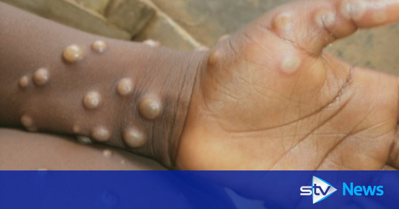 Two more cases of ‘potentially deadly’ mpox virus strain discovered in UK