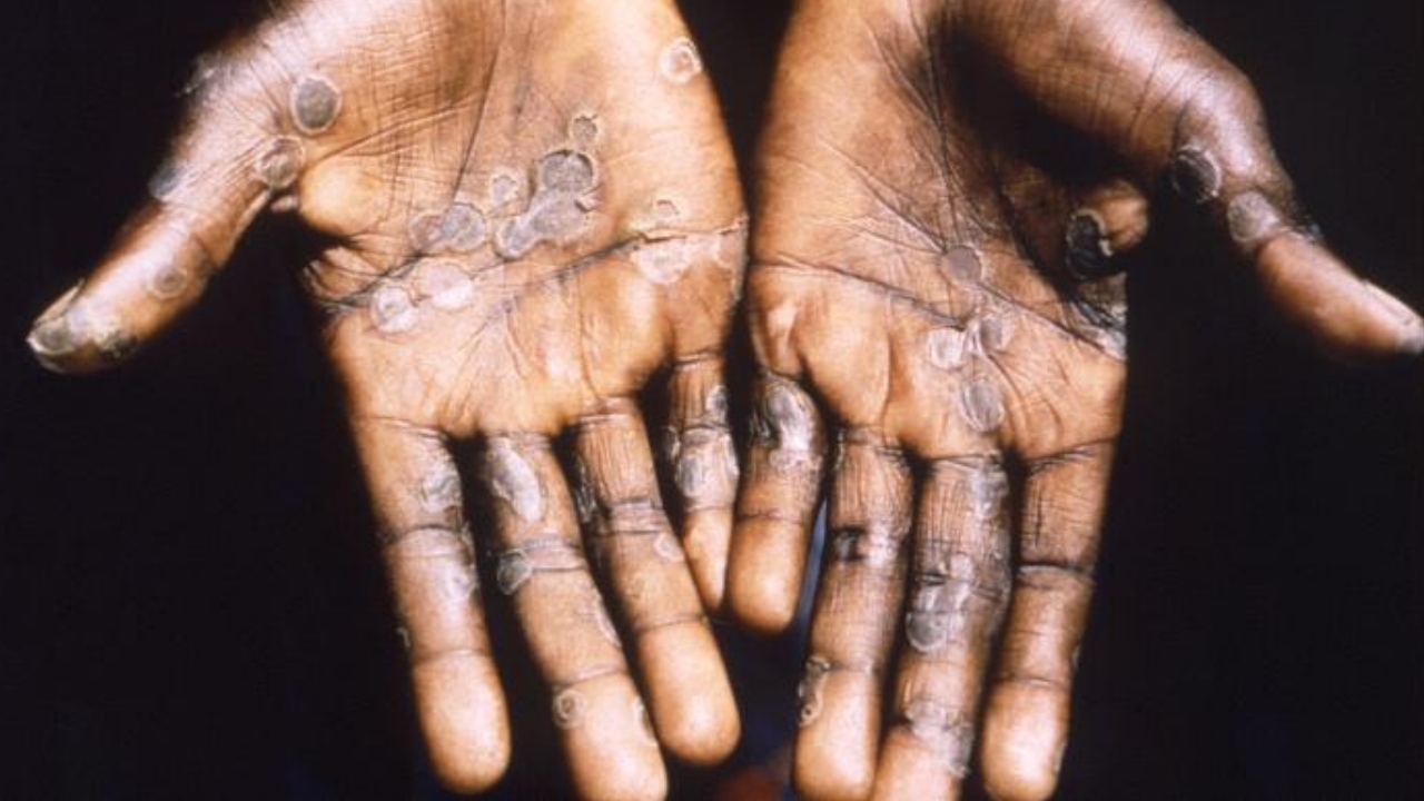 Monkeypox renamed ‘mpox’ by health experts ‘because of racism and stigmatising language’