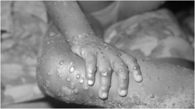 First case of monkeypox confirmed in Scotland as cases surge across UK