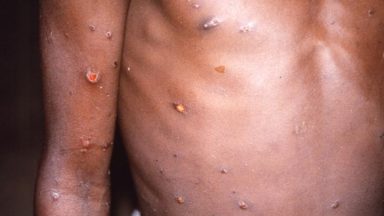 Four people being treated for monkeypox in Scotland, health officials confirm