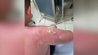 Shaun Devenney left with third-degree burns after being sold out-of-date sun cream from the Original Factory Shop