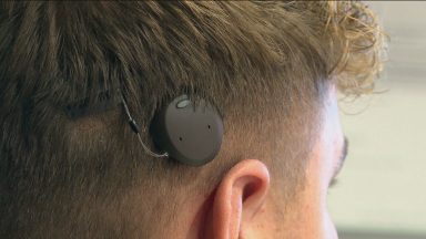 Teenager first in Scotland to get revolutionary new hearing aid