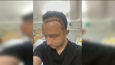 Man given headache tablets before being diagnosed with brain tumour