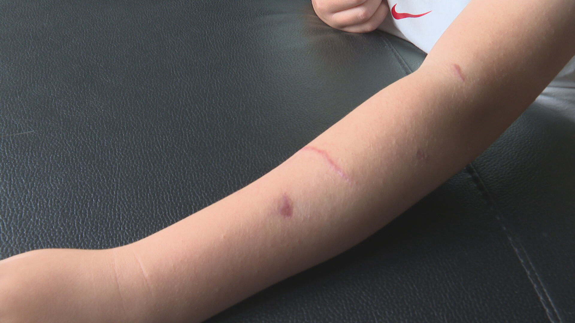 The boy has scarring on his left arm following the attack.
