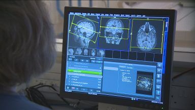Breakthrough made in treatment of Alzheimer’s disease