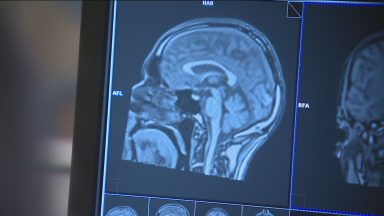 Experts condemn decision to cut stroke treatment funding