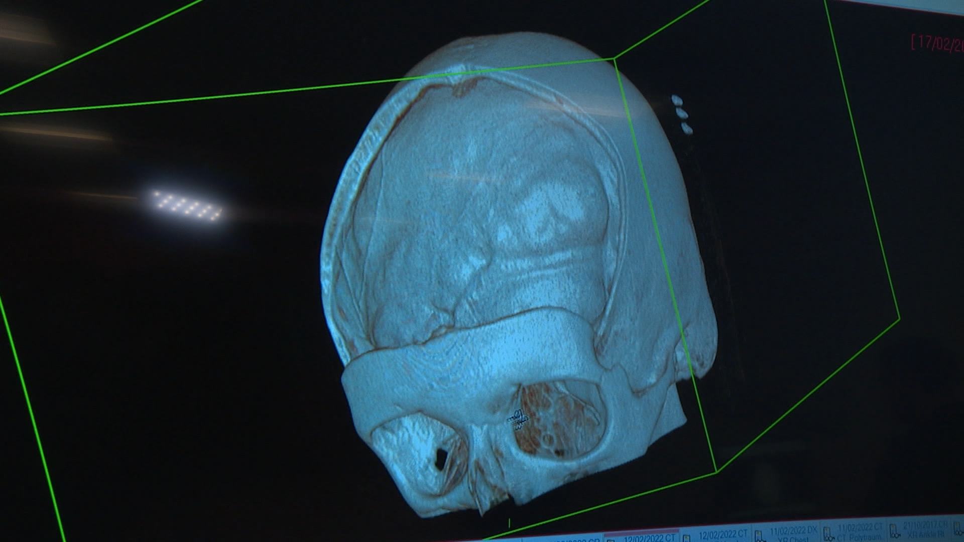 A 3D model of what Chelsey's skull looked like after part of it was removed.  
