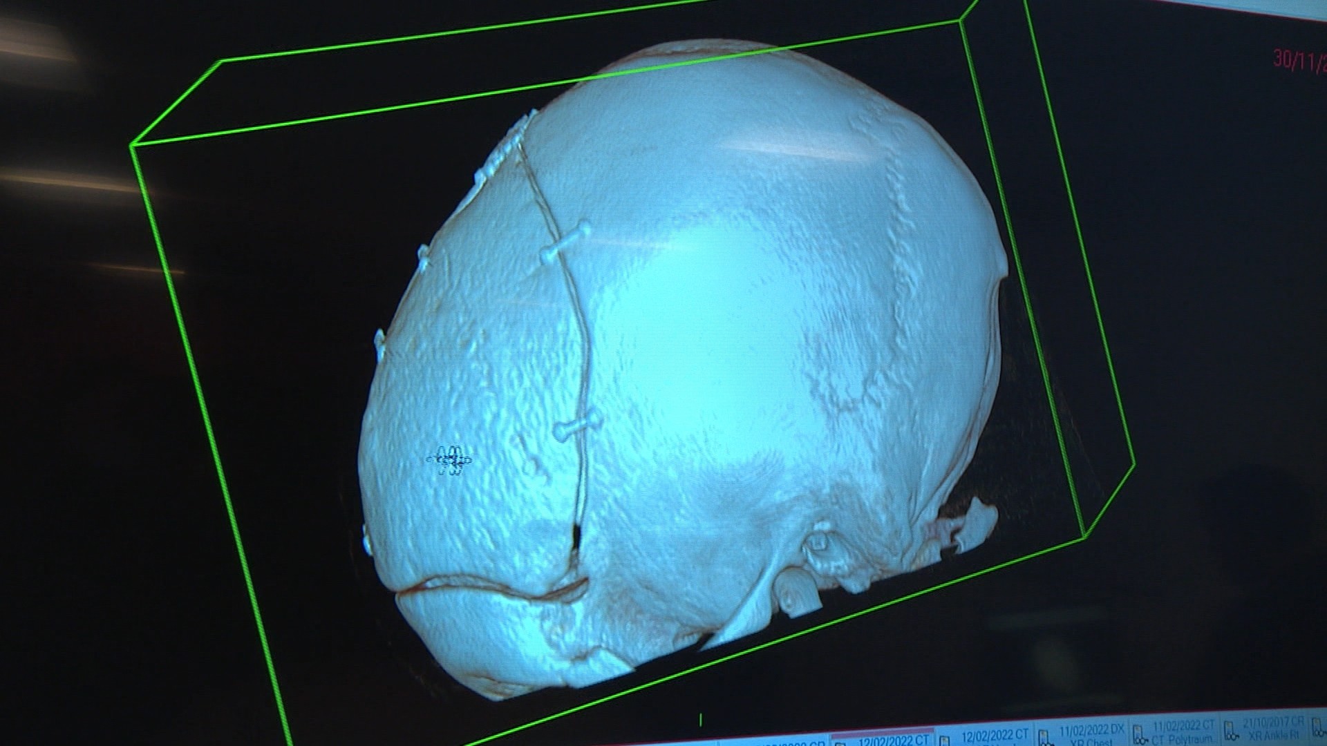 This is how Chelsey's skull looks now: it was reinserted during her recovery. 