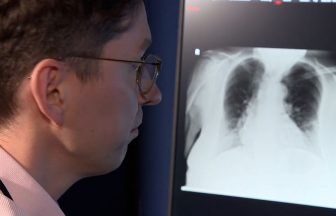 NHS Grampian radiology department trialling artificial intelligence technology to screen for cancer