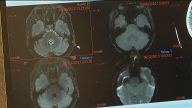 Potential new stroke treatment using already existing drugs