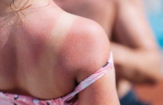 Scots warned of sunburn risk after just 30 minutes in the sun due to high UV levels in Scotland this week