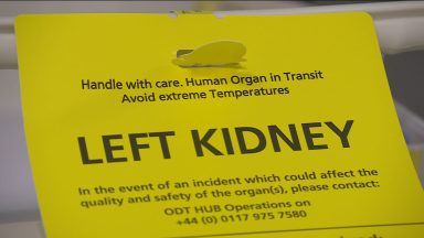 Number of kidney donations and transplants hits record high