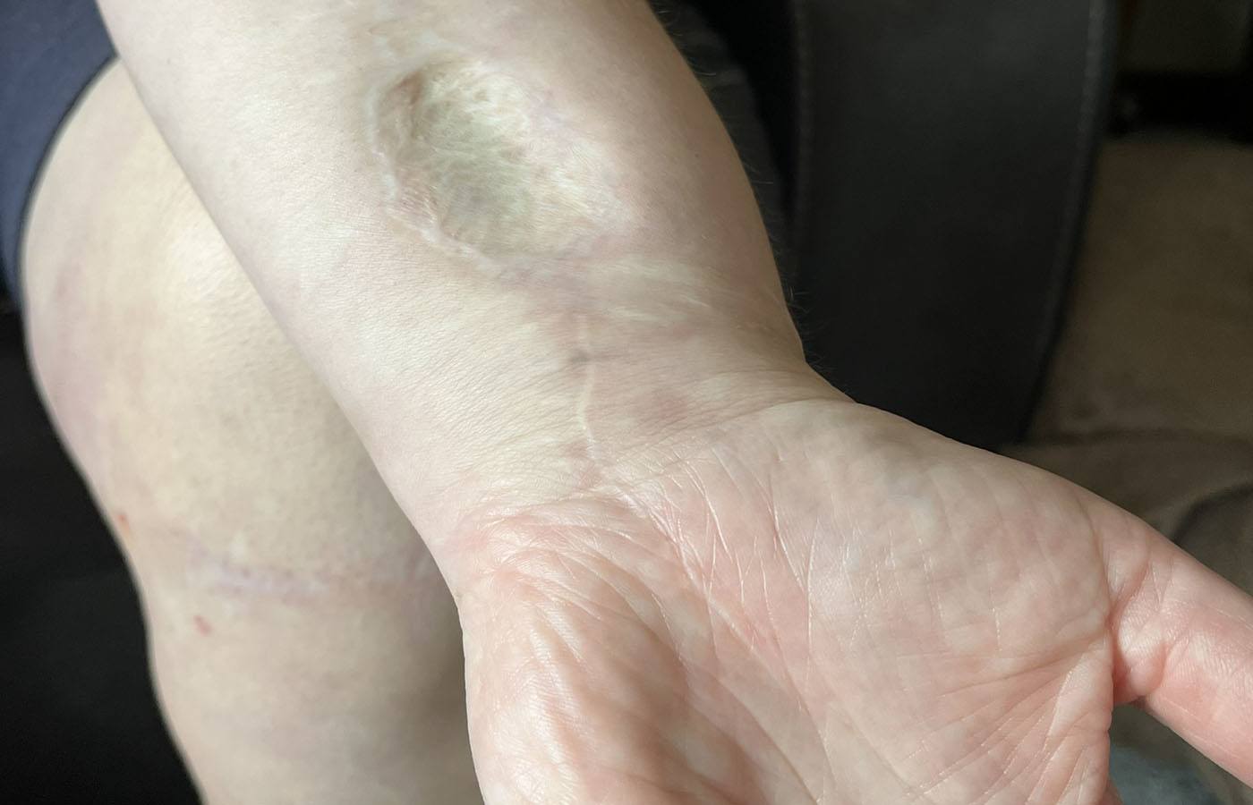 Gear stick wound on Morag Smith's wrist.