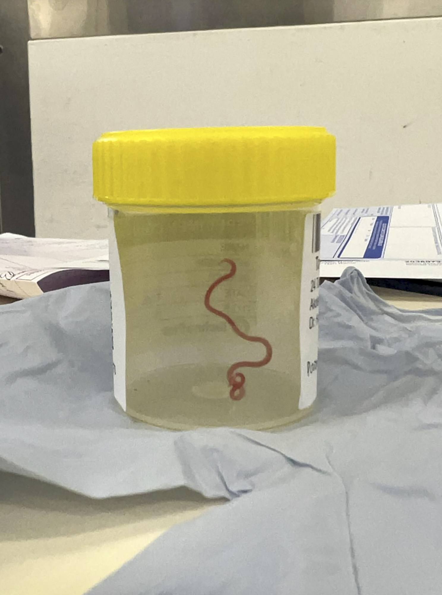 The 3in parasitic worm was found in a woman’s brain during a biopsy at Canberra Hospital.