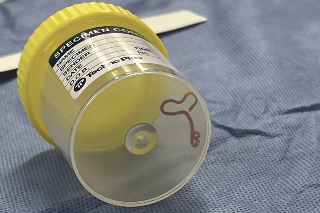 Surgeon probing Australian woman’s mystery symptoms plucks worm from her brain