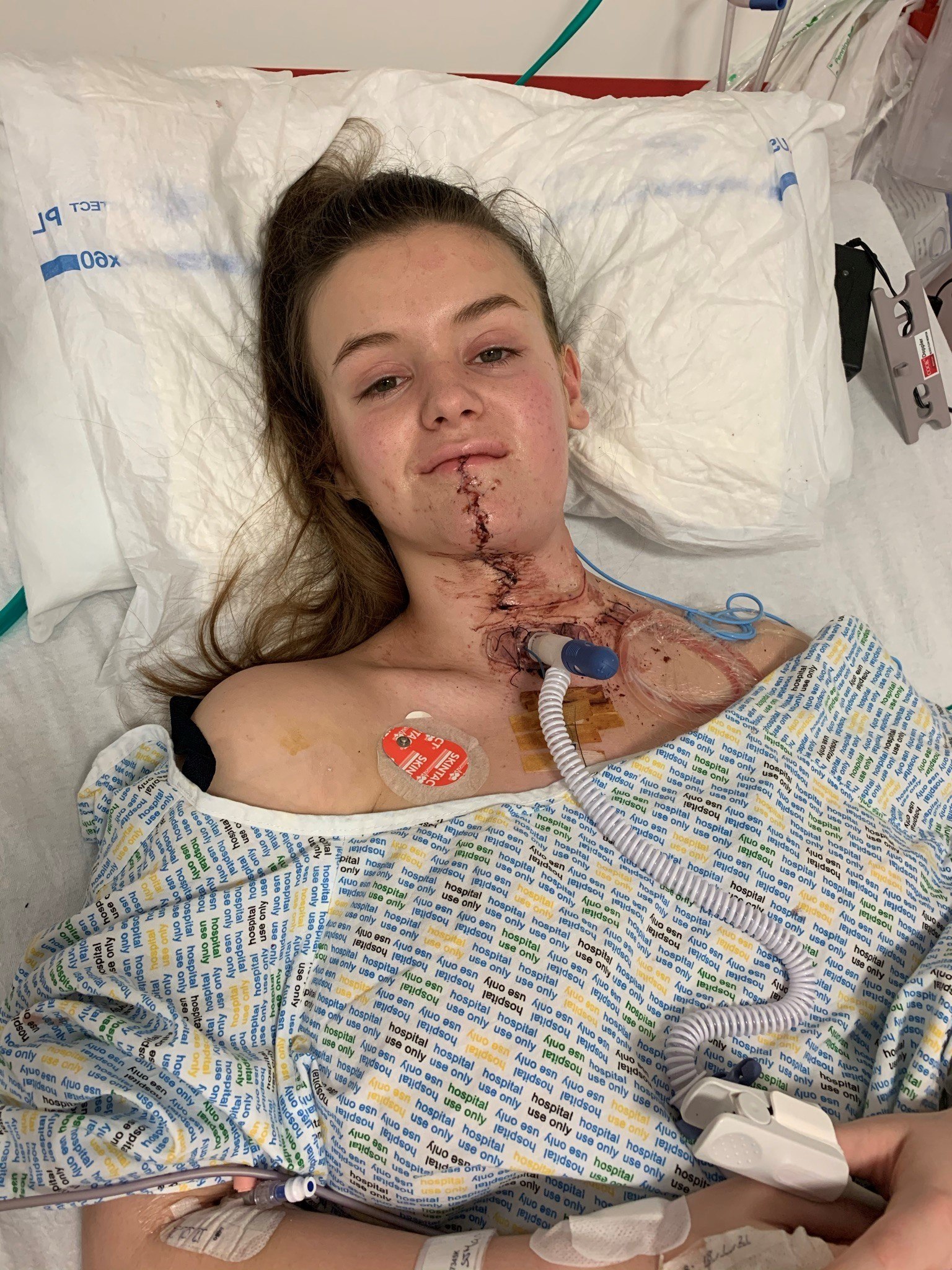 Rachel, who was in her second year of university, was rushed into surgery for a 16-hour operation.