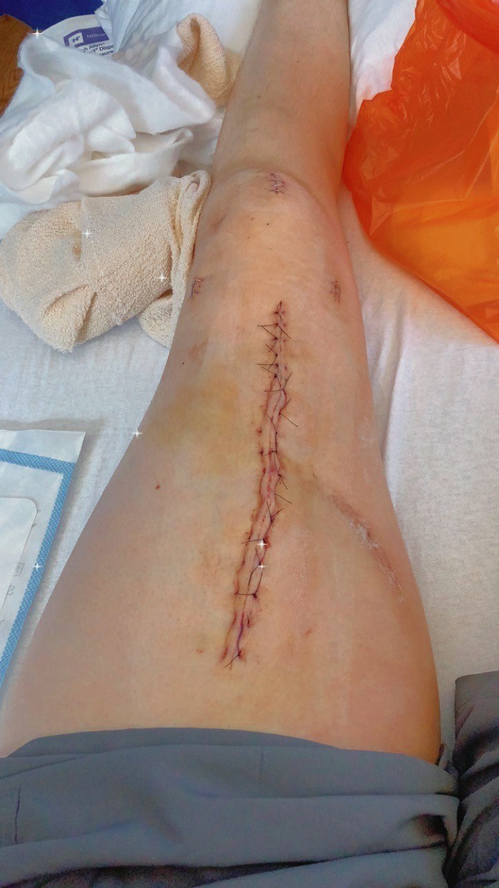 Taylor's scars following 12-hour operation 