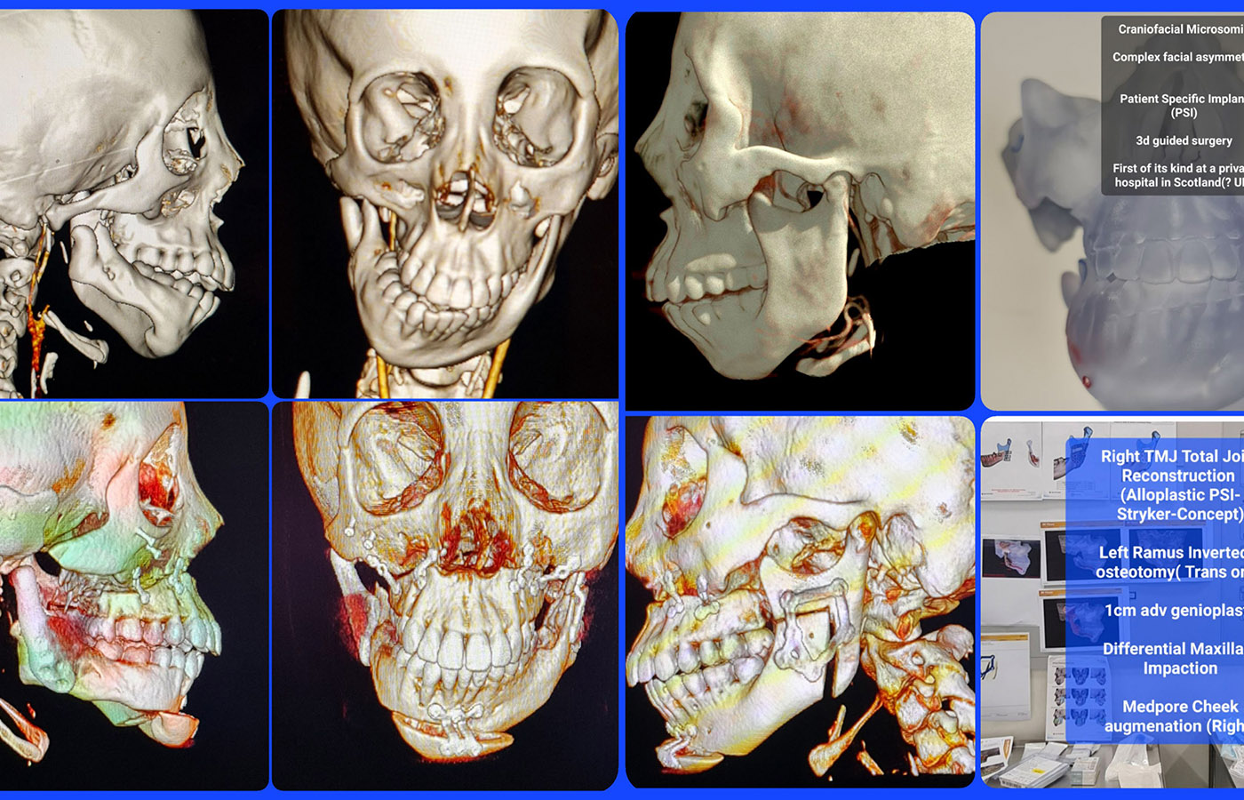 Facial reconstruction. (Scan images showing the extent of complex facial & jaw joint reconstructions).