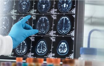 ‘There will be no dementia in the future’ – Scientists in Edinburgh hopeful of finding cure for brain conditions