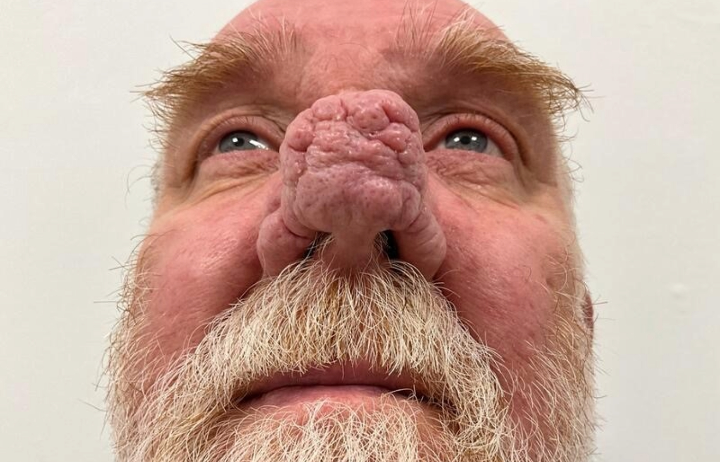 Ian Arthur turned reclusive after his rhinophyma worsened.
