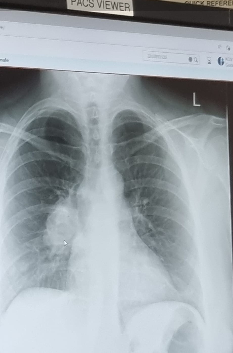 A chest X-ray showed the cancer was in Stephanie's lung.