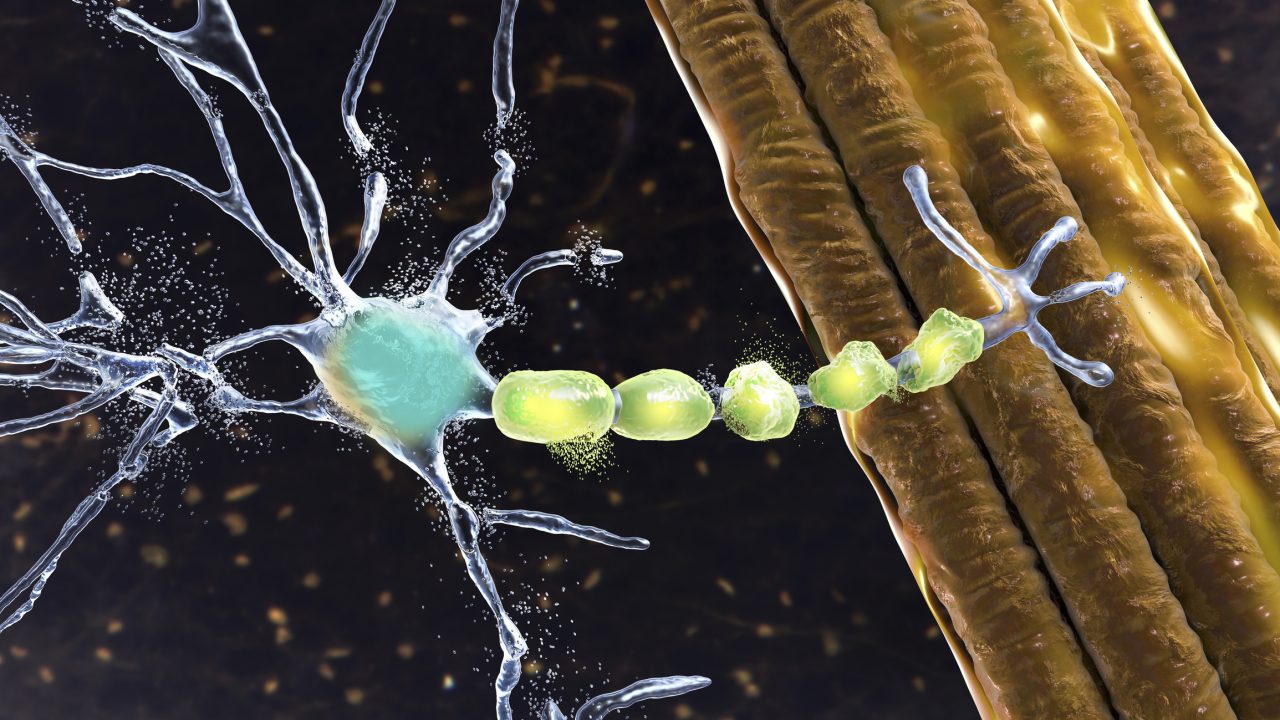 Degradation of motor neurons, conceptual computer illustration.