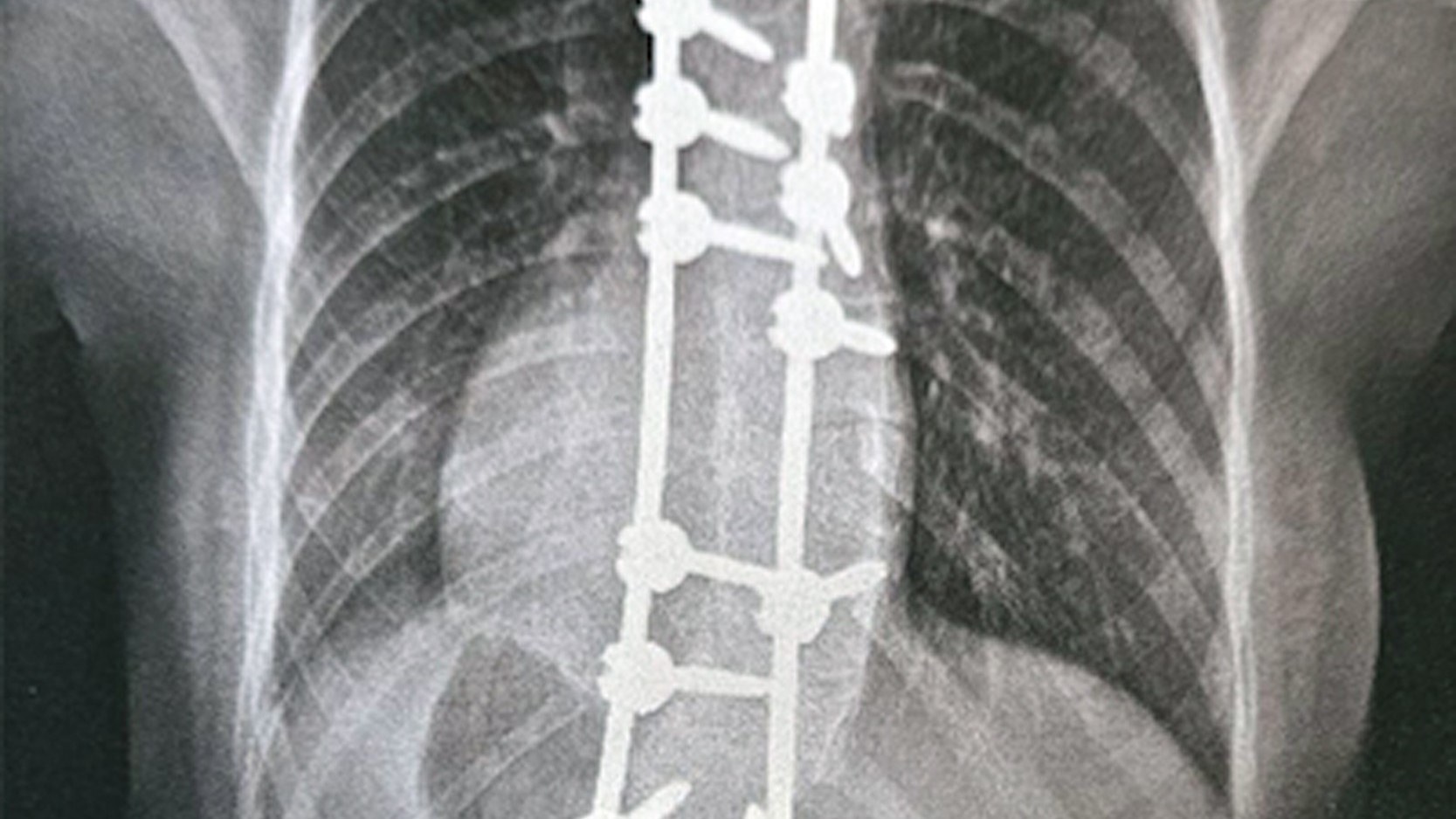 Leah had two steel rods attached to his spine to straighten the vertebrae