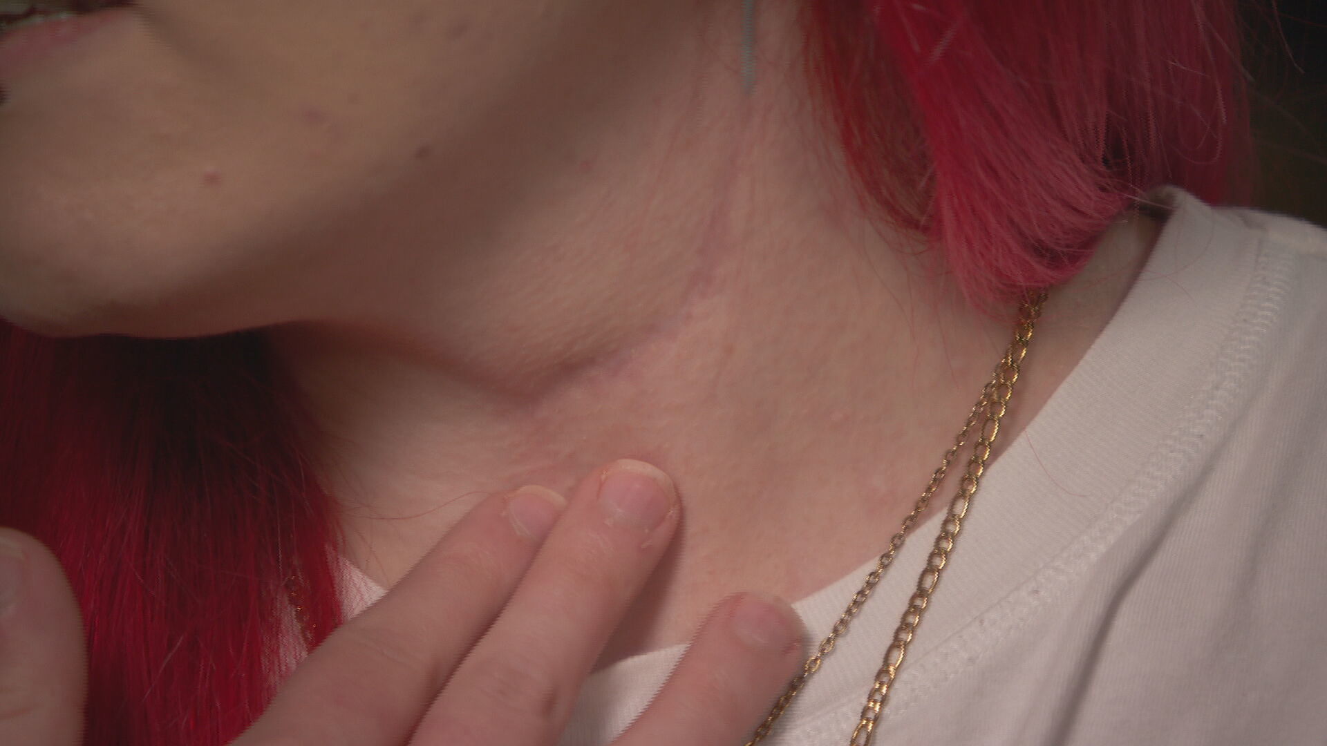 Victoria has been left with scars following surgery to remove her salivary gland tumour