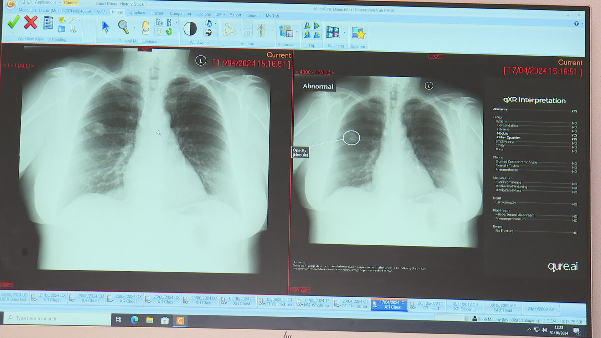 AI being used to detect 'abnormalities' in chest X-rays