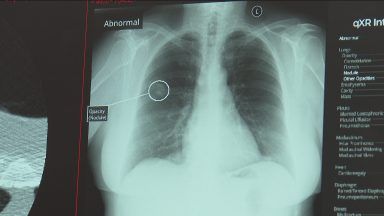 Gran’s lung cancer detected early thanks to pioneering AI technology