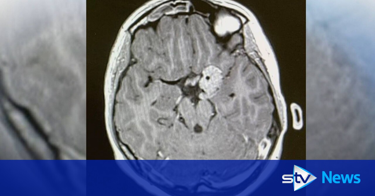 Student in fundraising hopes after rare brain tumour diagnosis