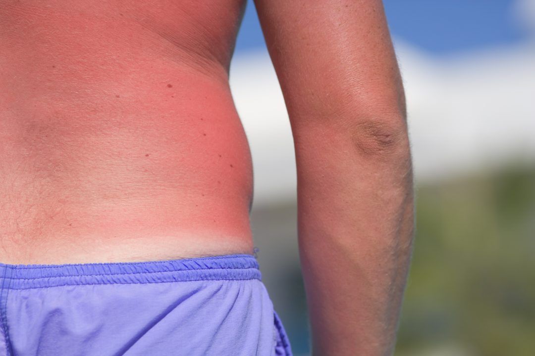 Almost half of Scots suffer sunburn at least once a year, research finds