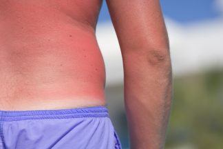 Almost half of Scots suffer sunburn at least once a year, research finds