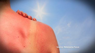 Warning as research finds almost half of Scots suffer sunburn at least once a year
