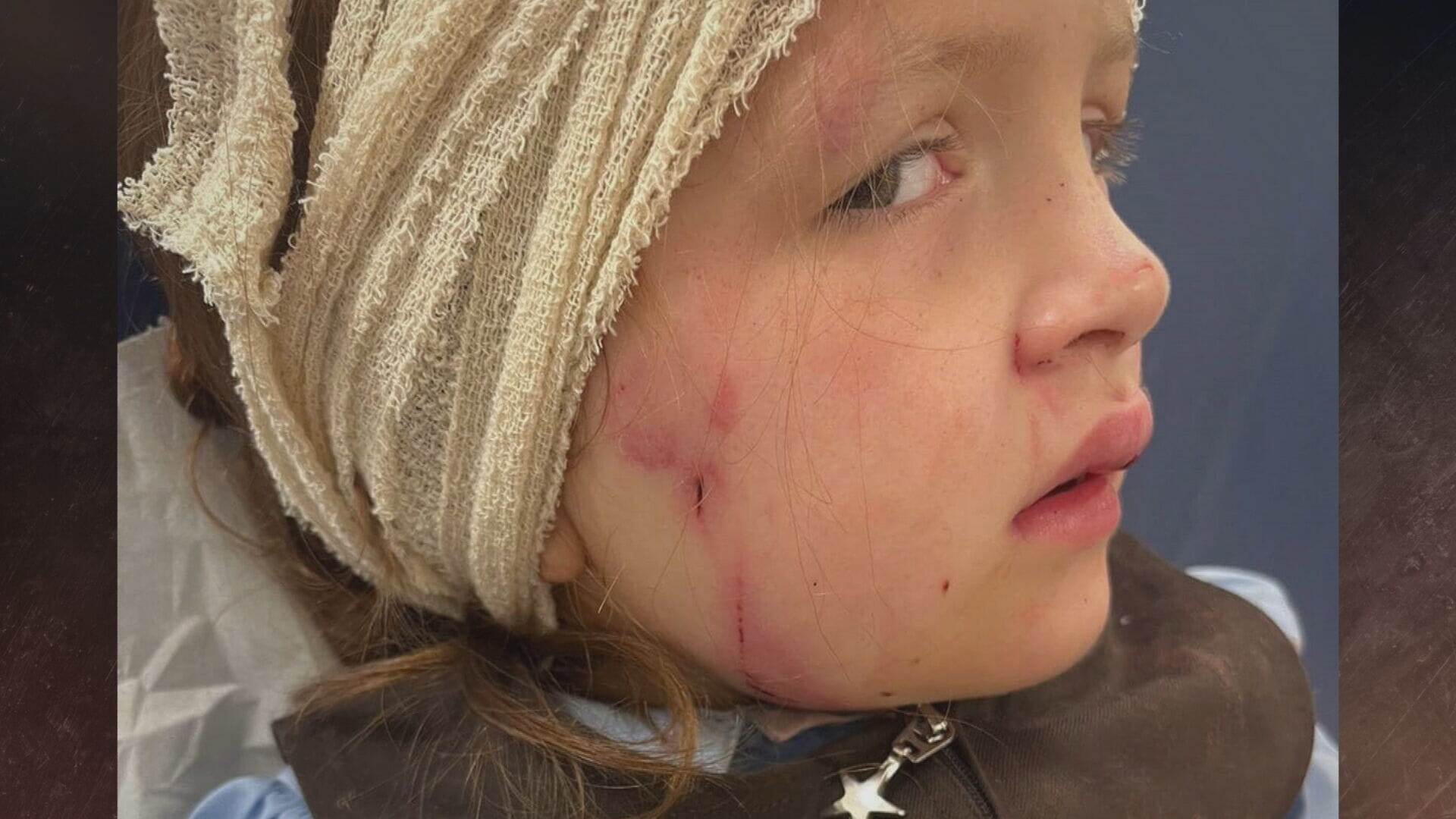 Rose was left scarred by the attack.