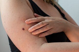 Researcher at Heriot-Watt develops AI tool could speed up skin cancer diagnoses in remote areas