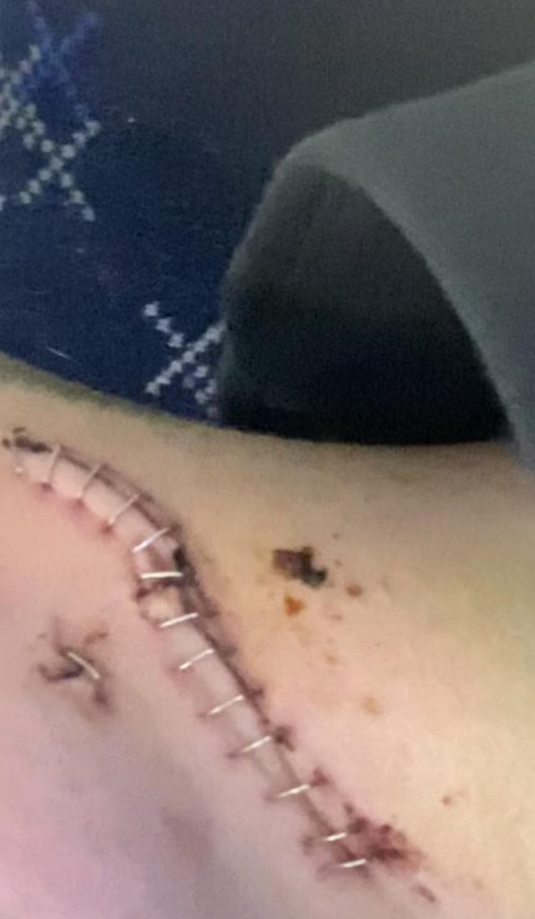 Conall Morrison required 14 staples to close the wound in his neck.