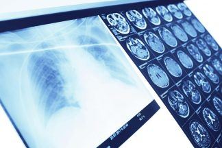 Minister admits it may take decade for full rollout of lung cancer screening