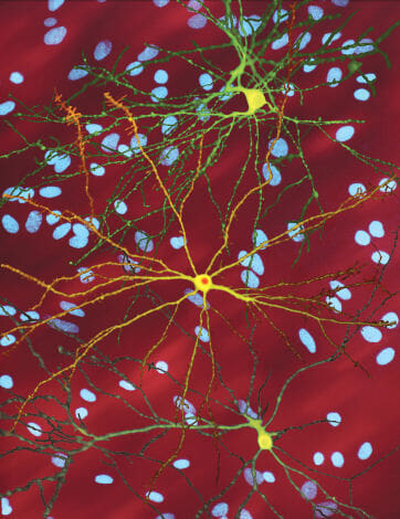 Charity hails breakthrough Huntington’s disease treatment amid high rates of the disease in north Scotland