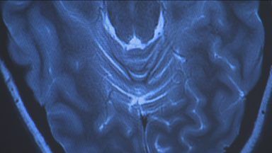 Scots researchers publish ‘landmark’ brain condition findings