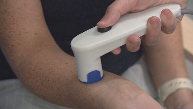 ‘Revolutionary’ skin sensor developed by Heriot Watt University could change how eczema is treated